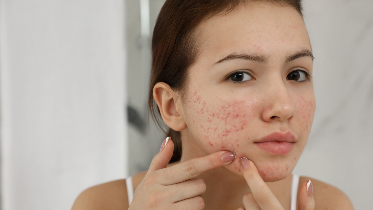 Adult Acne After 35: Why Your Skin Is Breaking Out More Now Than It Did as a Teenager